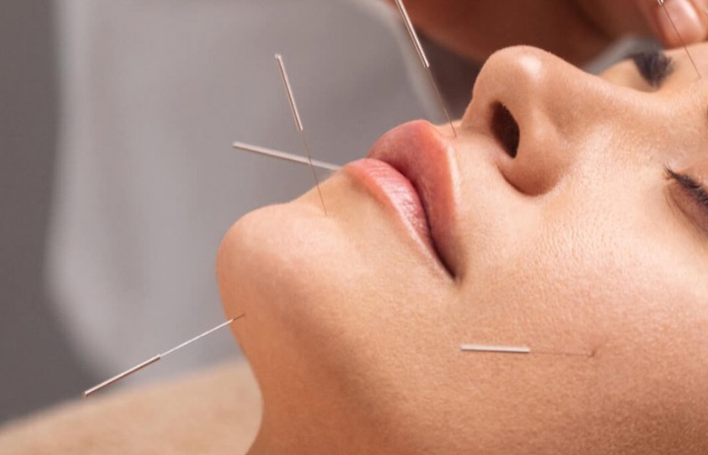 Kozmetik Akupunktur Hakkında Bilmen Gereken Her Şey!